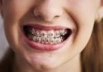 Braces, The Key to Achieving a Flawless Smile