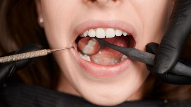 Everything You Need to Know About Tooth Fillings