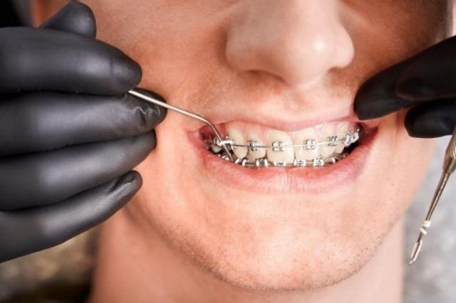 How to Manage Braces Pain, A Complete Guide?