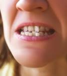 Crowded Teeth in Kids, Early Signs and Treatments