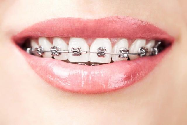 How to Keep Your Smile Clean with Metal Braces?