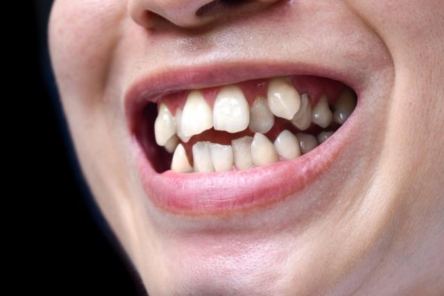 How Dentists Fix Overlapping Teeth in Adults and Teens?