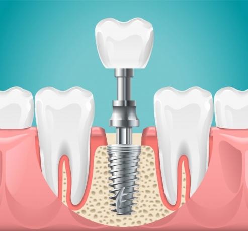 Am I a Candidate for Dental Implants?