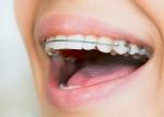 How Much Do Dental Appliances Cost?