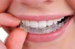 How Do You Clean a Mouthguard Properly?