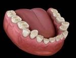 How Does a Dentist Diagnose Teeth Grinding?