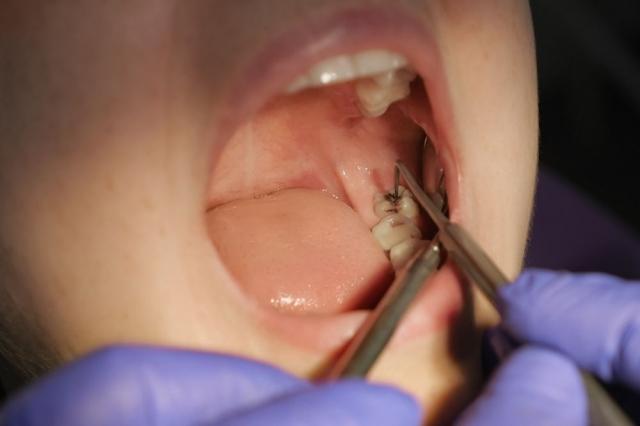 How Long Does a Wisdom Tooth Extraction Take?