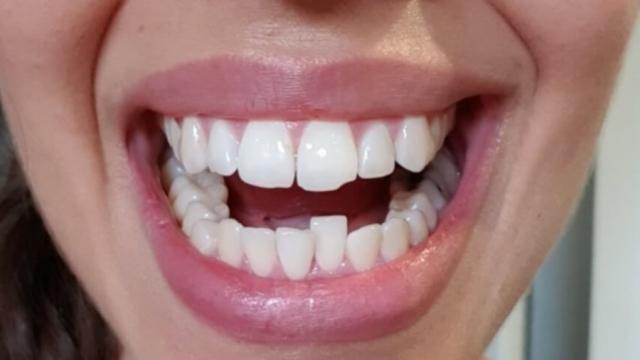 Are Clear Aligners Effective for Crowded Teeth?