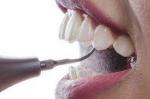 Can Teeth Scaling Whiten My Teeth?