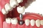 Who Is a Good Candidate for Dental Implants?