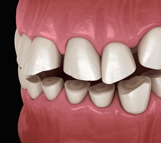 How Do Dentists Treat Chronic Bruxism?