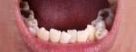 Are Overlapping Teeth Considered a Dental Problem?
