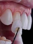 Does Dental Bonding Hurt?
