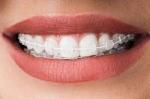 What Happens During a Braces Appointment?