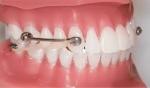 How to Clean Your Dental Appliance Safely?