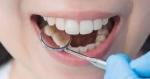 What Procedures Are Involved in Full Mouth Rehab?