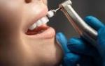Should I Get Teeth Polishing If I Brush Daily?