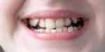What Are the Best Braces for Overlapping Teeth?