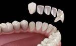 How to Maintain Your Composite Veneers?