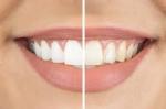 Does Teeth Whitening Hurt?