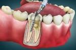 Is Root Canal Treatment Painful?