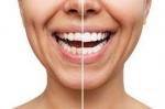 Do Dental Veneers Hurt? Common Patient Questions