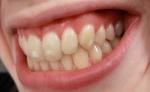 Is Dental Stain Removal Painful?