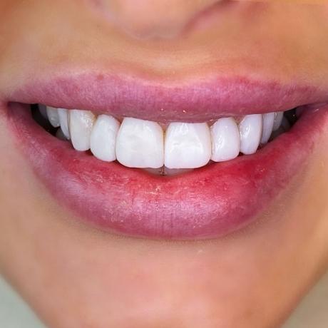 Will Composite Bonding Look Natural?
