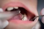 Do I Need a Root Canal on My Back Tooth?