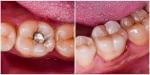Does Amalgam Removal Release Mercury Into the Body?