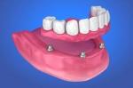 How Much Do Dentures Cost in 2025?