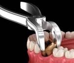 Signs You Might Need a Tooth Extraction