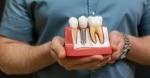 How Long Do Same-Day Dental Implants Last?