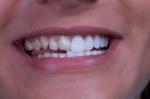 Dental Veneers: Cost Breakdown & What to Expect