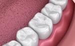 Do Composite Fillings Hurt?