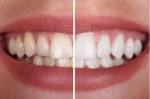 Does Zoom Teeth Whitening Hurt?