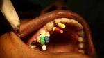 Aftercare Tips for Root Canal Recovery