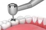 Does Insurance Cover Amalgam Filling Removal?