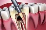 Common Myths and Facts About Root Canal Therapy
