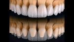 How Strong Are Zirconia Crowns Compared to Others?