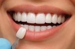 How Much Do E-max Veneers Cost in Dubai?