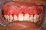 How Much Does Gum Depigmentation Cost?