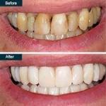 How Do Dentists Clean Your Teeth Step by Step?