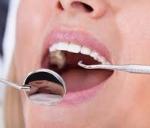 What causes nerve inflammation after tooth filling?