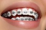 How do you clean teeth with braces on?