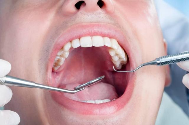 How Much Does Full Mouth Rehabilitation Cost?