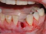 Does Tooth Extraction Hurt After the Procedure?