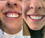 Are Gummy Smile Treatments Painful?
