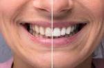 How Many Shades Whiter Can I Get with Zoom Whitening?