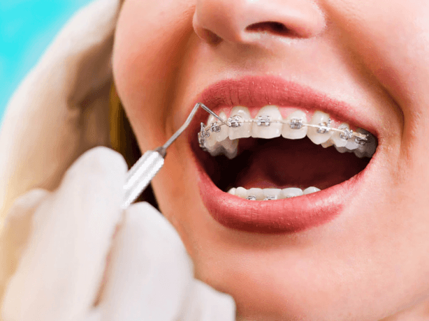 How Often Should I Visit the Orthodontist With Braces?